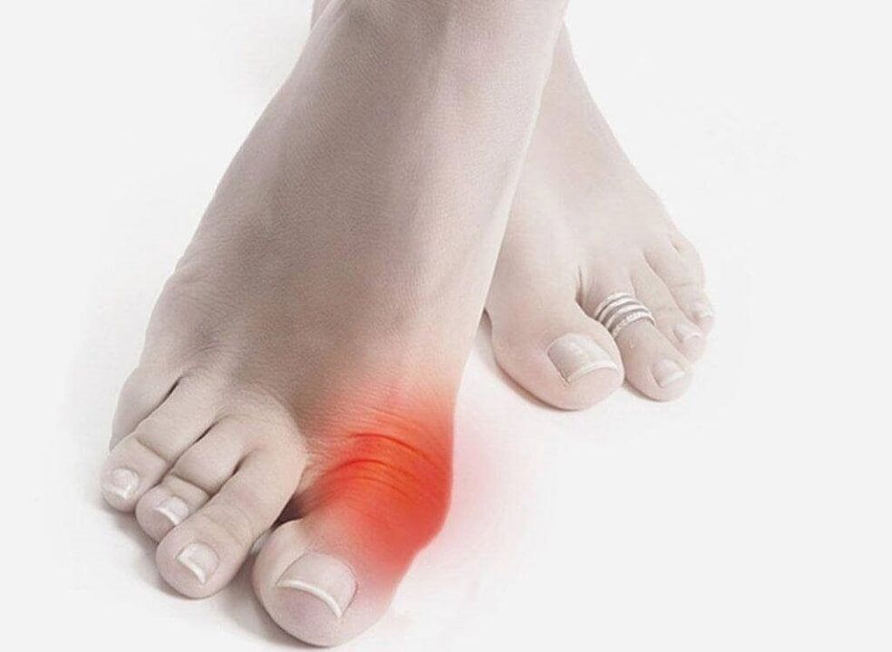 symptoms of gout foot